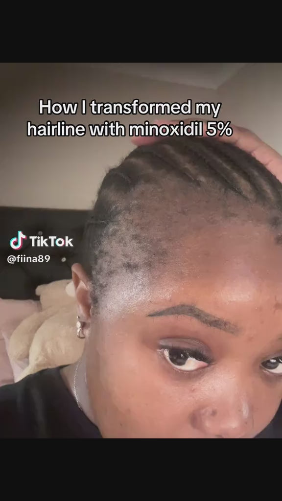 MINOXIDIL